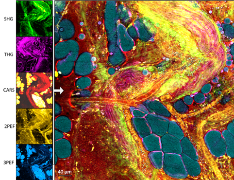 Multimodal label-free images (SHG, THG, CARS, 2PEF, 3PEF) and composite image of a fresh unperturbed mammary tumor from a carcinogen-injected rat.